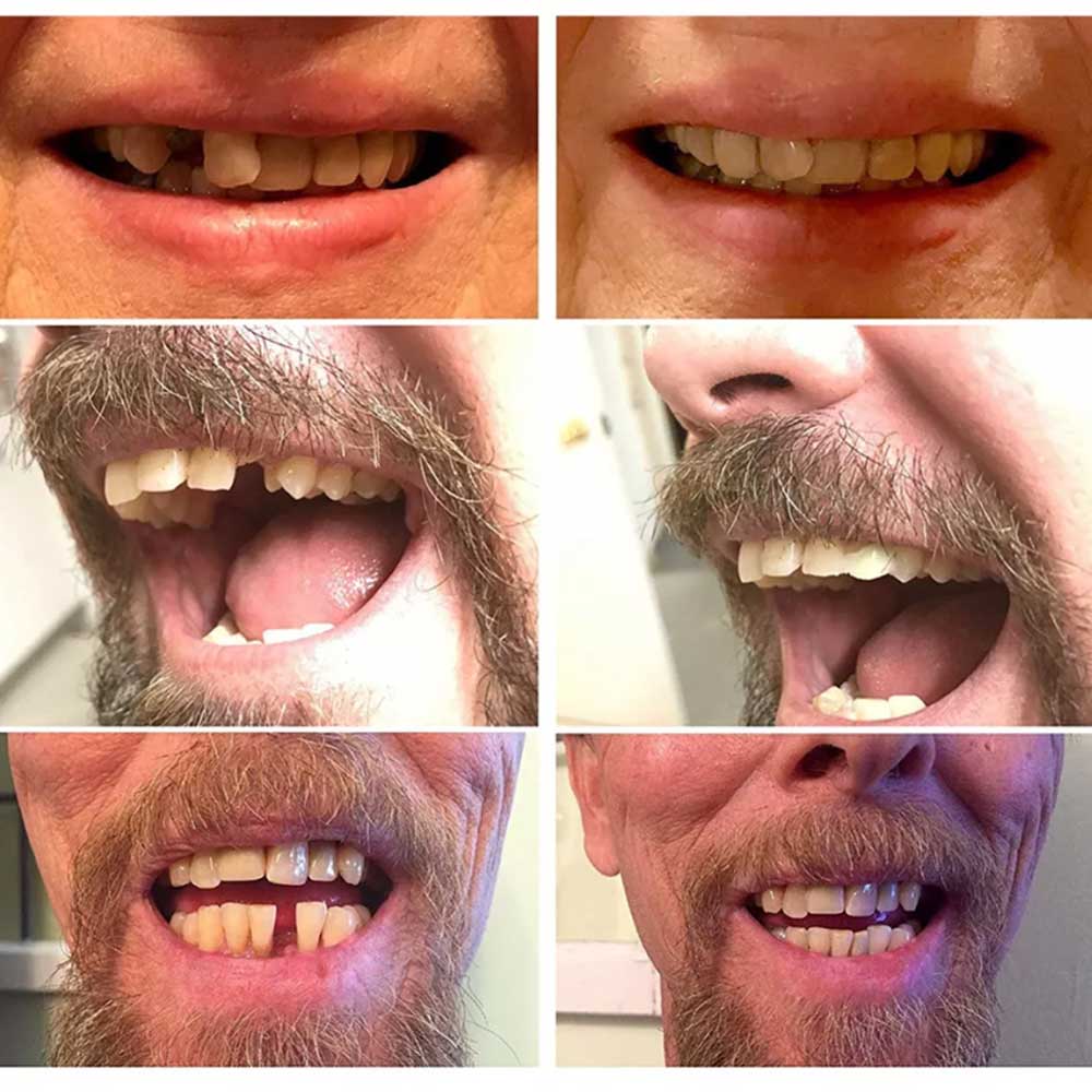 3X Instants Smile Comfort Fit Flex Teeth Top Temporary Teeth Replacement Repair