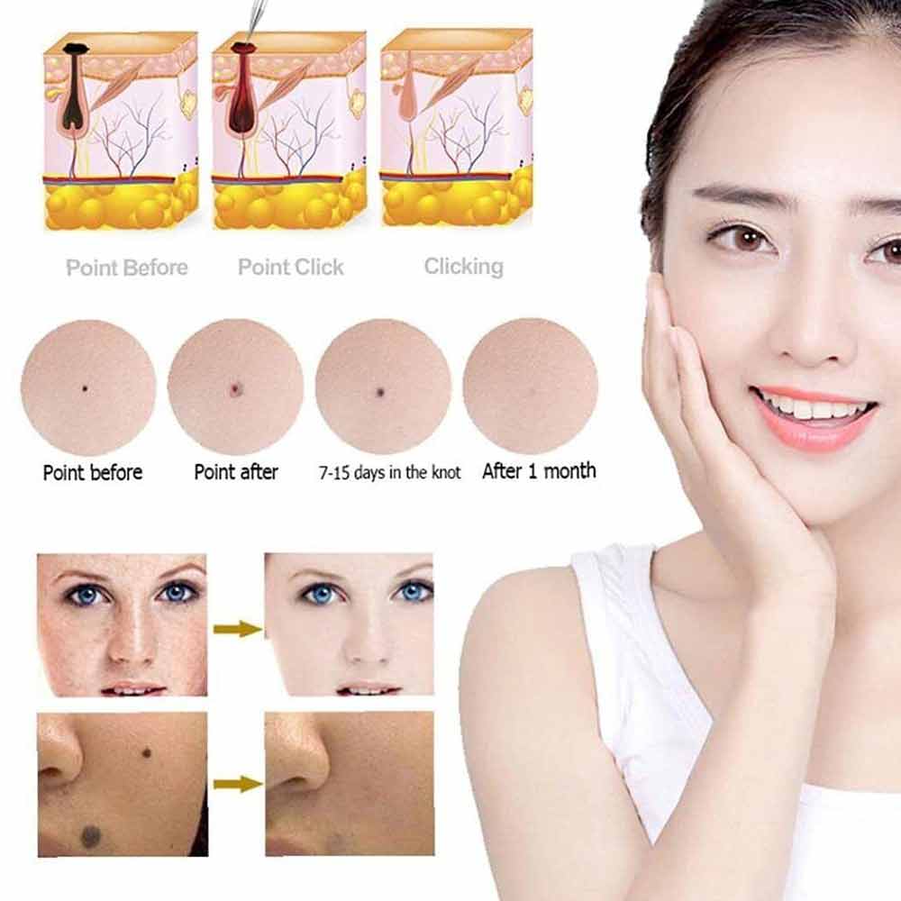 Laser Plasma Pen Freckle Remover Machine LCD Skin Mole Wart Dark Spot Removal