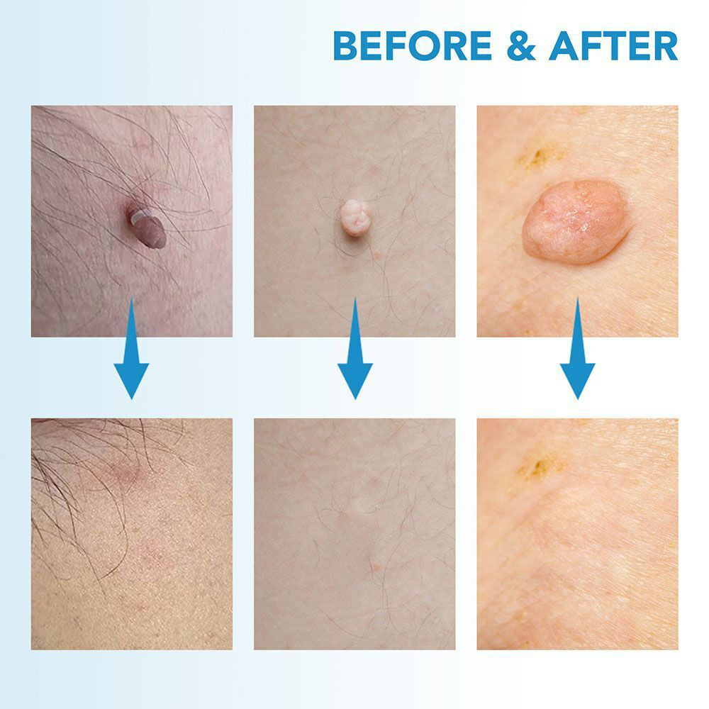 Auto Micro Skin Tag Remover Device Kit Safe Painless Removal 2-8 mm Band Tool